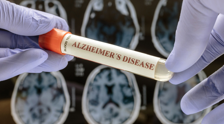 La maladie d’Alzheimer est incurable.