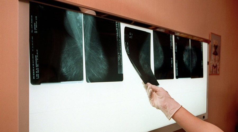 Cancer du sein : ces polluants qui augmentent le risque de métastases