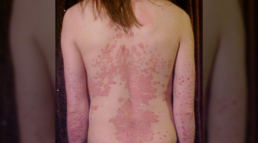 Une révolution naturelle dans le traitement du psoriasis