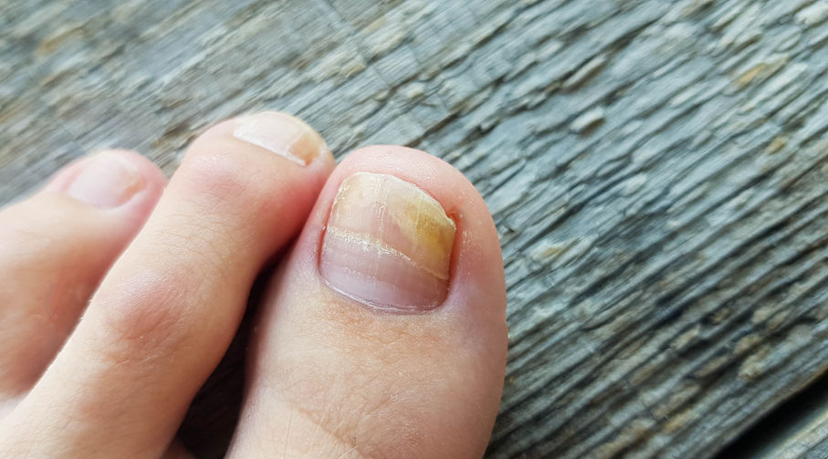 Limes à ongles : nid à mycoses ?