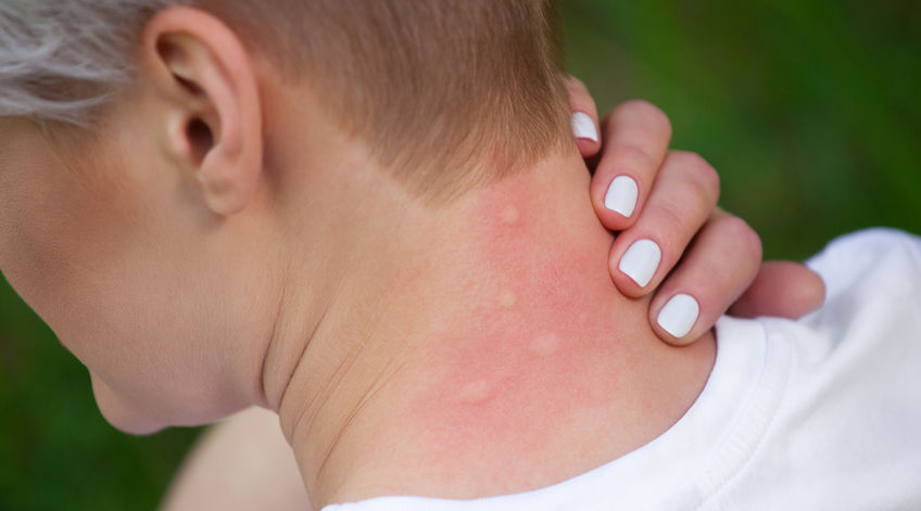 allergie piqure insecte